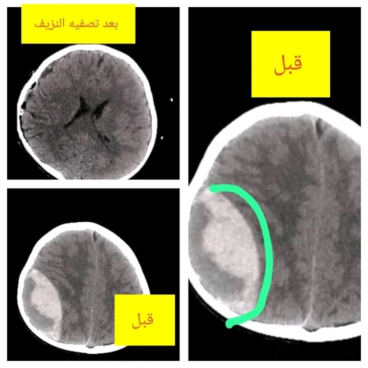 أطباء في شبوة ينجحون في إنقاذ طفل من نزيف دماغي “حاد” بعملية جراحية طارئة
