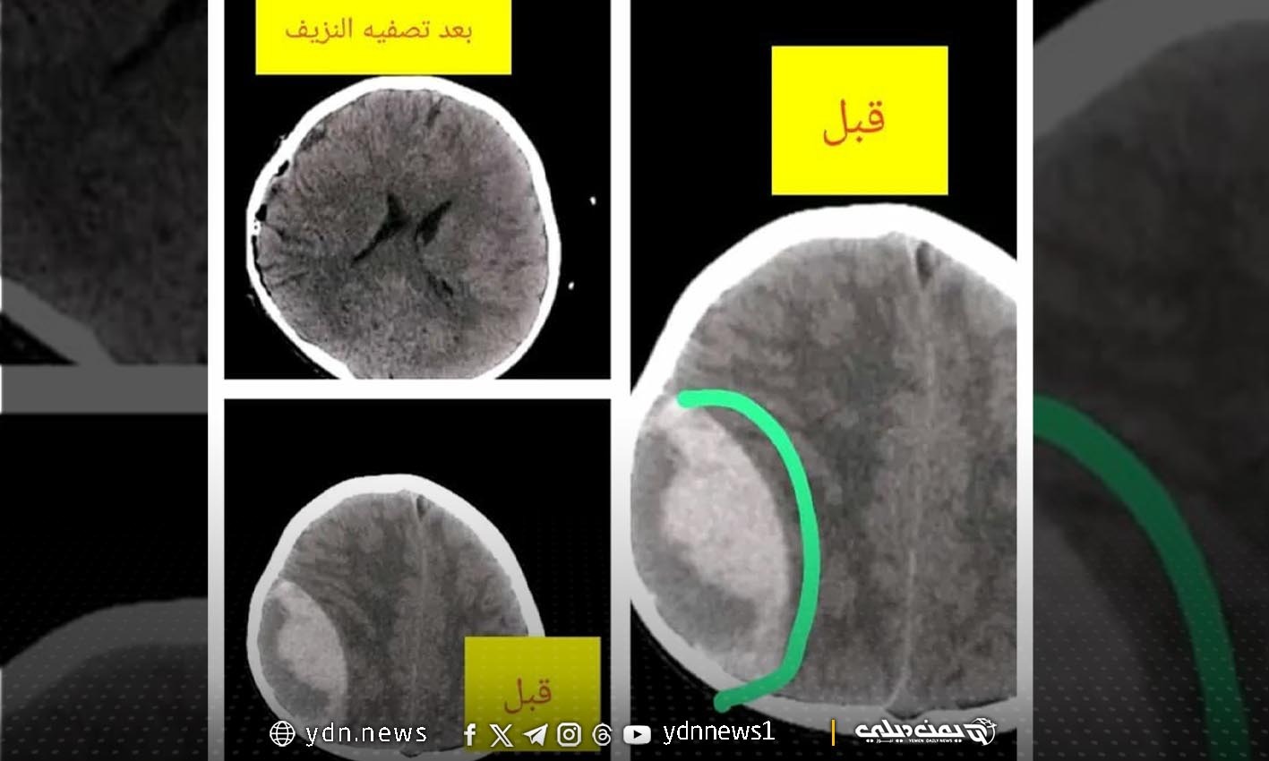 أطباء في شبوة ينجحون في إنقاذ طفل من نزيف دماغي “حاد” بعملية جراحية طارئة